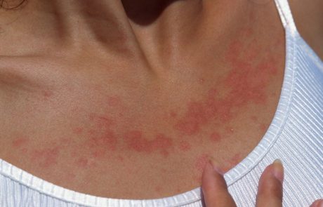 SOS poletje: Ob alergiji na sonce kožo treba ohladiti in pomiriti