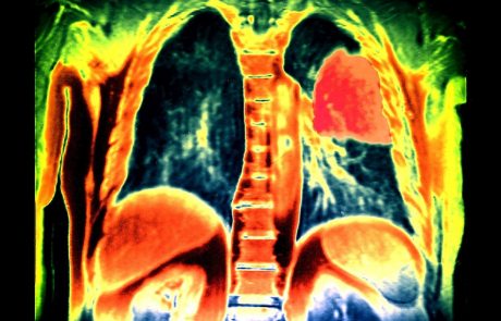 Če pljučnega raka odkrijemo zgodaj, imamo 60-odstotno možnost za ozdravitev