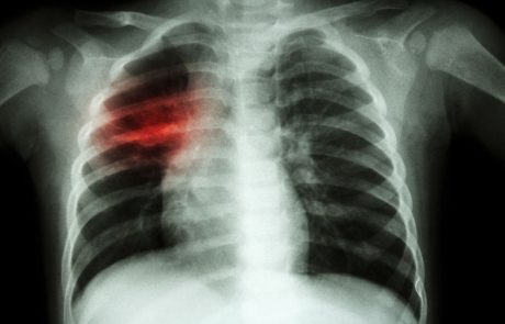 Pljučnica bolj smrtonosna od malarije, tuberkuloze, ošpic in aidsa skupaj