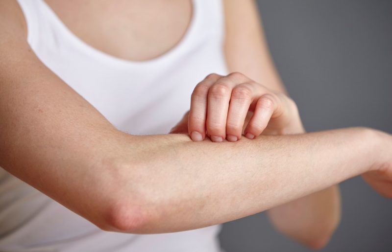 Simptom, ki kaže na pomanjkanje cinka, pojavi pa se na koži