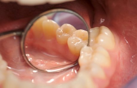 Znanstveniki po naključju odkrili zdravilo za obnavljanje zob