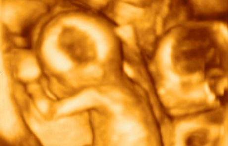 Mlada ženska rodila deveterčke, dva otroka več kot pa so jih zdravniki z ultrazvokom našteli med nosečnostjo