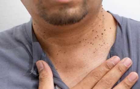 Ne ignorirajmo sumljivih madežev na koži: Zgodnje odkrivanje kožnega raka je ključno za uspešno zdravljenje